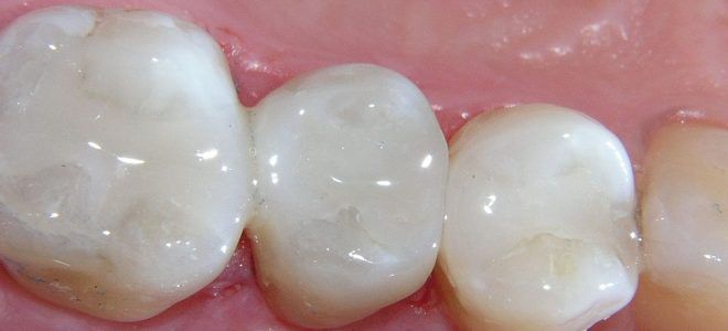 Виды зубных пломб пластмасса