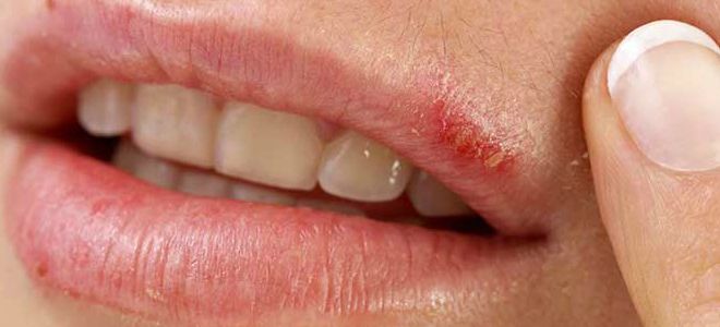 причины появления простуды на губах