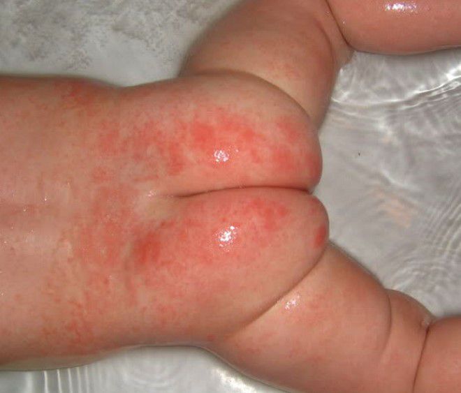 Стрептоцид и дерматит пеленочный дерматит thumbnail