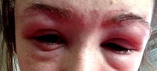 аллергия на коже вокруг глаз