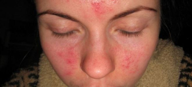 Аллергия на косметику на глазах симптомы и лечение thumbnail