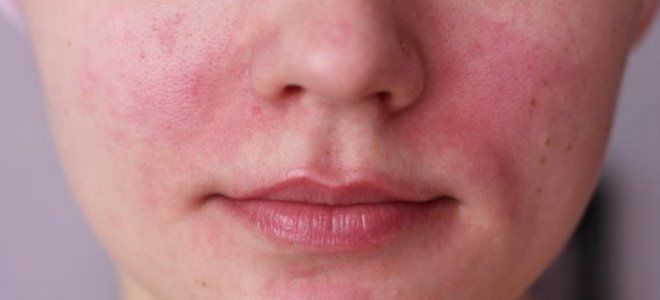 аллергия на косметику симптомы