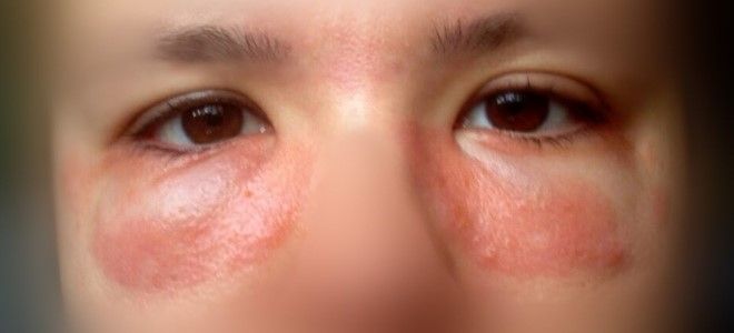 аллергия на косметику на глазах