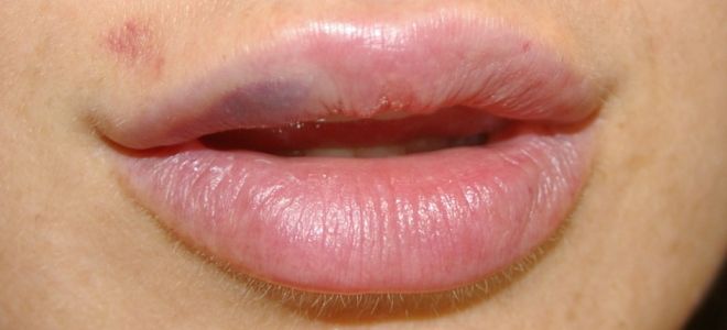 увеличение губ гиалуроновой кислотой последствия