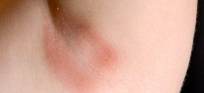 стафилококковая пиодермия у детей гидраденит
