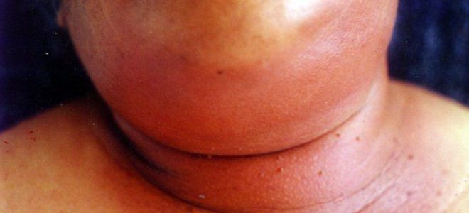 Флегмона челюстно лицевой области