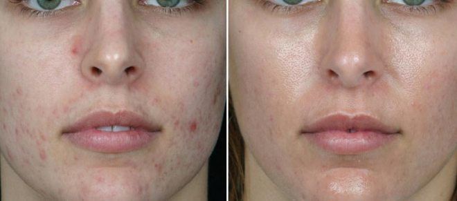 ультразвуковая чистка лица до и после фото