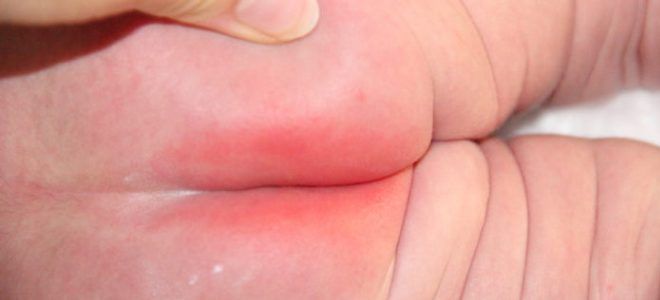 Почему у ребенка сыпь на ягодицах thumbnail