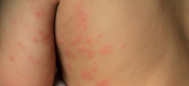 Аллергическая сыпь у детей три