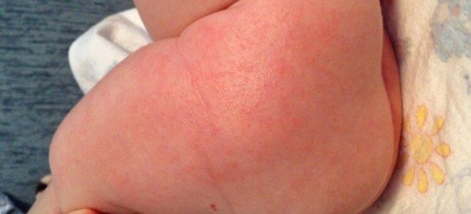 Аллергическая сыпь у детей четыре
