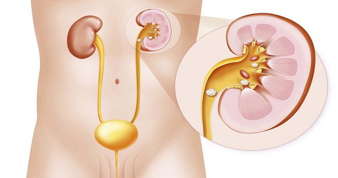 Мочекаменная болезнь: симптомы и лечение у женщин, если камни в мочевом пузыре, мочеточниках, почках