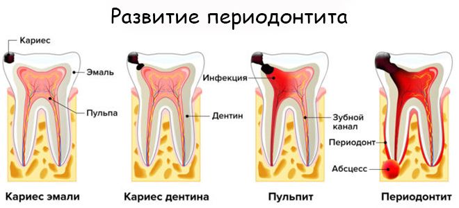 Воспаление корней зубов лечение периодонтита thumbnail