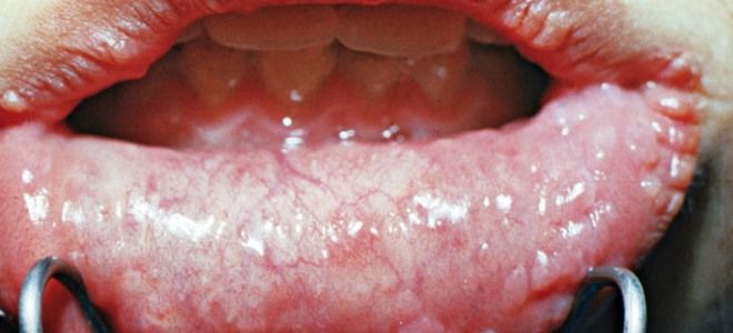 сифилис полости рта