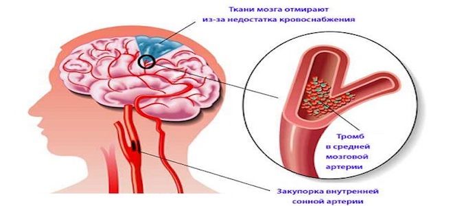 атеросклероз сосудов головного мозга причины возникновения