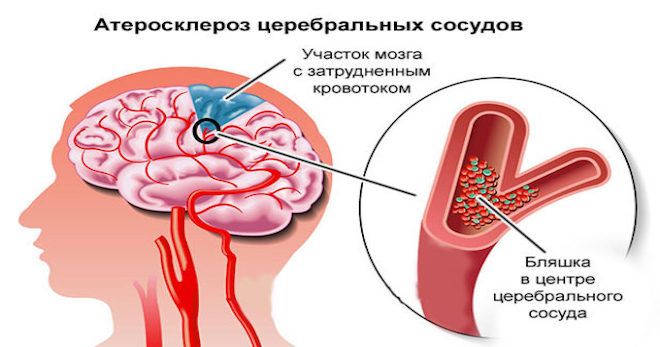 атеросклероз церебральных сосудов