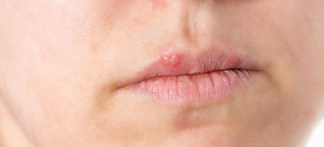 герпес на губах после антибиотиков