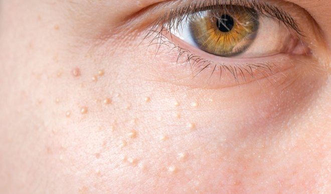 вирусные заболевания кожи лица