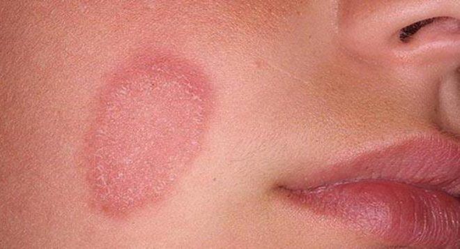 грибковые заболевания кожи лица