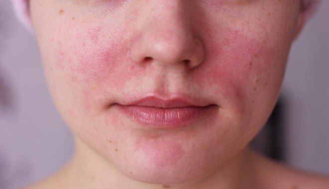 аллергические заболевания кожи