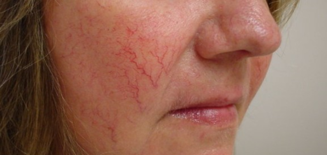 сосудистые заболевания кожи лица