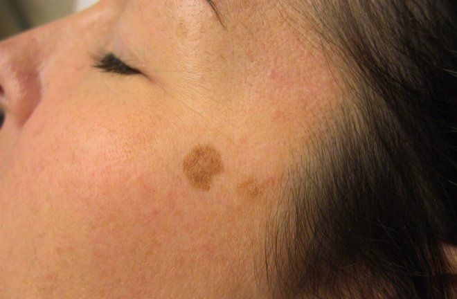 онкологические заболевания кожи на лице