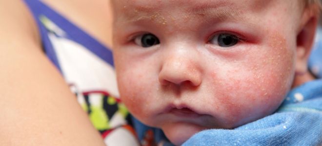 Как выглядит аллергический дерматит у детей два