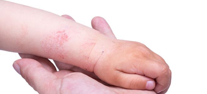 Как выглядит аллергический дерматит у детей четыре