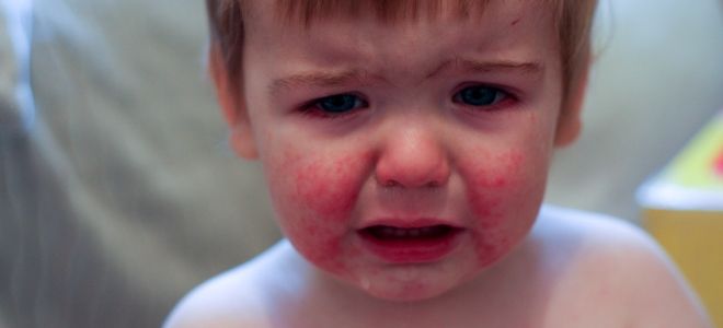 Как выглядит аллергический дерматит у детей пять