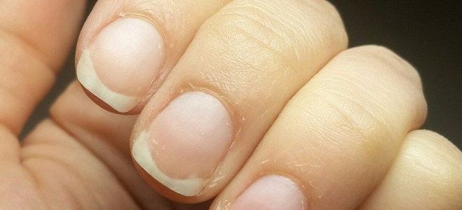 средство от онихолизиса ногтей