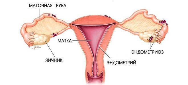 лечение эндометриоза у женщин