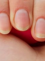Ломкость ногтей – причины