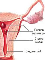 Беременность и полип эндометрия