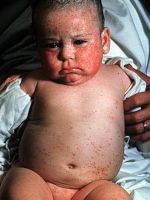 Цитомегаловирусная инфекция у детей - лечение