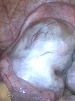 Эндометриоидная киста правого яичника