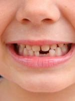 Какие зубы выпадают у детей?