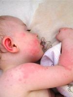 Мазь от аллергии для детей