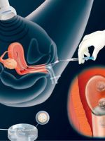 Подсадка эмбрионов при ЭКО 