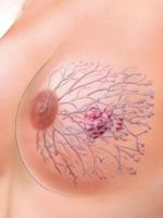 Протоковый рак молочной железы