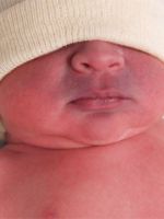 Синеет носогубный треугольник у новорожденного
