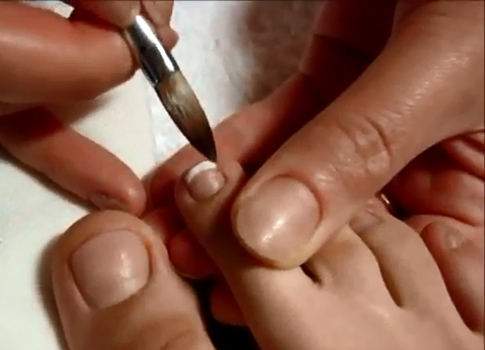Toenail extension step by step 3