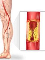 Нарушение кровообращения нижних конечностей – симптомы