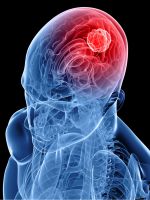 Рак головного мозга – симптомы