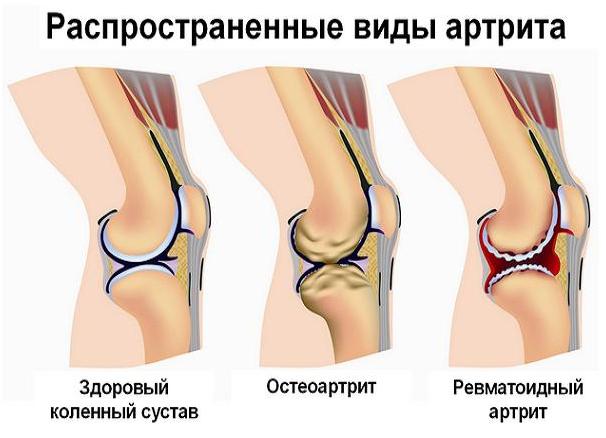 Боль в суставах ног - причины появления симптома, способы лечения
